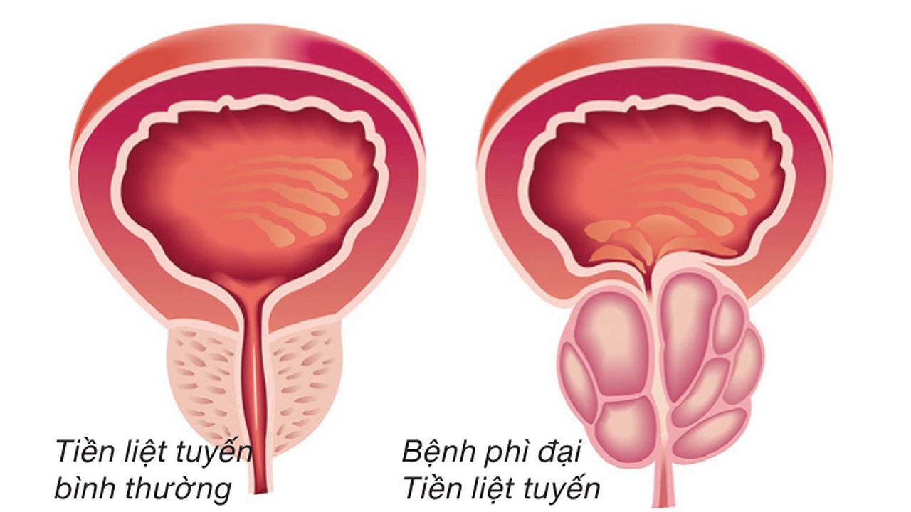 Cách điều trị u xơ tuyến tiền liệt hiệu quả nhất