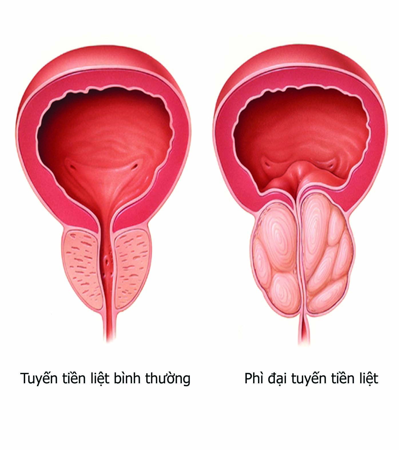 dieu tri u xo tuyen tien liet 1