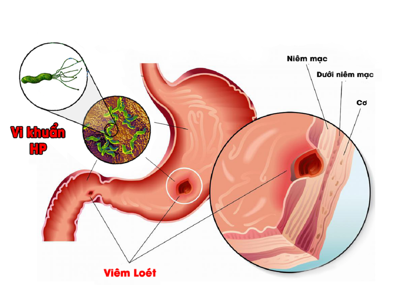 Cách điều trị viêm dạ dày có HP