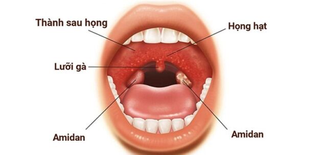 Cách điều trị viêm hầu họng