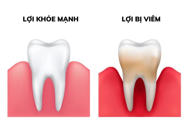 Cách điều trị viêm lợi dứt điểm, không tái phát