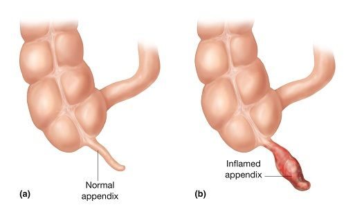 Cách điều trị viêm ruột thừa cấp