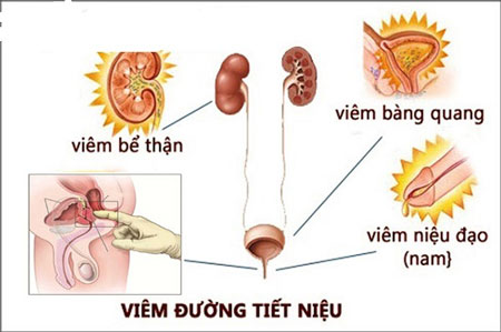 dieu tri viem tiet nieu nam 2