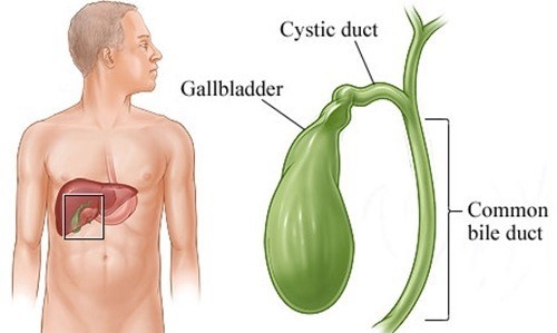 Cách điều trị viêm túi mật kịp thời, có thể gây biến chứng