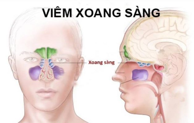 Cách điều trị viêm xoang sàng theo đúng cấp độ bệnh