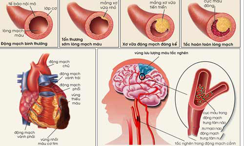 Cách điều trị xuất huyết não bằng cách nào và hiệu quả