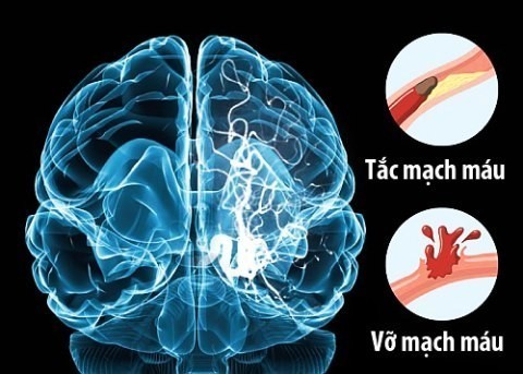 Cách điều trị xuất huyết não bằng cách nào và hiệu quả