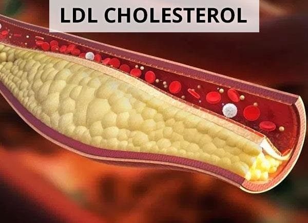 Cách giảm LDL cholesterol trong máu hiệu quả khi nào