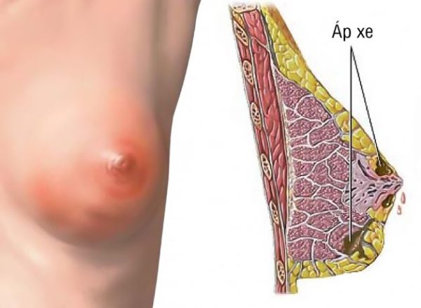 Cách khắc phục tắc tia sữa nặng mà mẹ nên biết