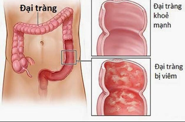 Cách lập kế hoạch chăm sóc bệnh nhân viêm đại tràng