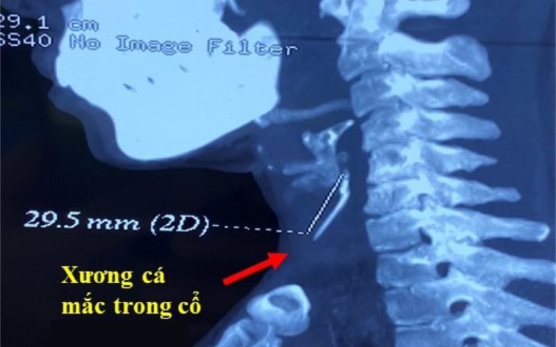 Cách lấy xương cá đâm vào họng: Hướng dẫn chi tiết