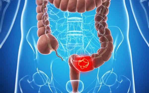 Cách loại bỏ ung thư đường tiêu hóa từ khi còn “trứng nước”