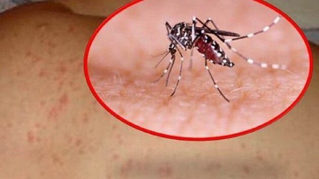 Cách nào phân biệt rõ sốt xuất huyết và sốt virus