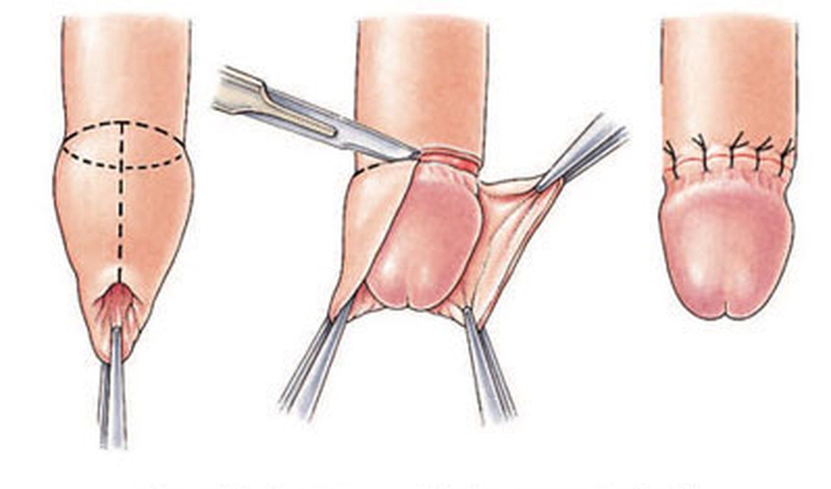 Cách nhận biết hẹp bao quy đầu ở trẻ em