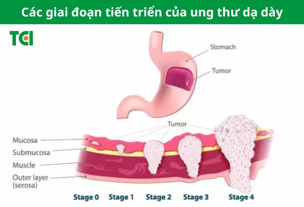 Cách nhận biết ung thư dạ dày từ giai đoạn đầu