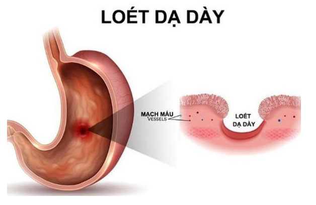 Cách nhận biết viêm loét dạ dày để khắc phục