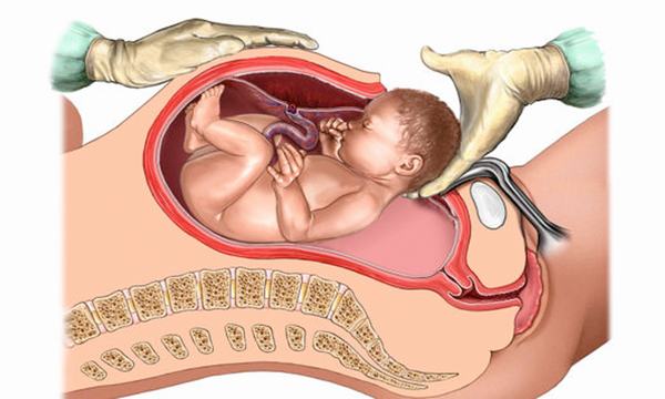 Cách nhận biết xương chậu hẹp và những ảnh hưởng tới chị em