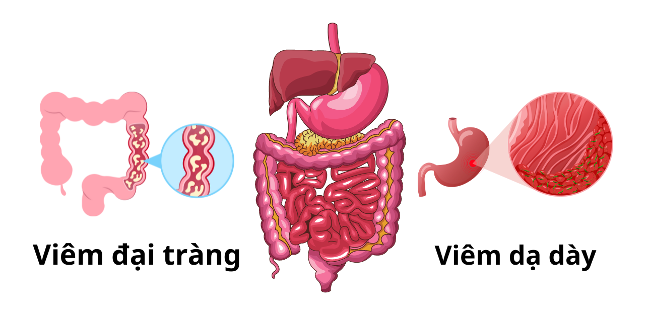 Cách phân biệt viêm đại tràng và dạ dày