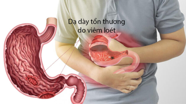 Cách phân biệt viêm đại tràng và dạ dày