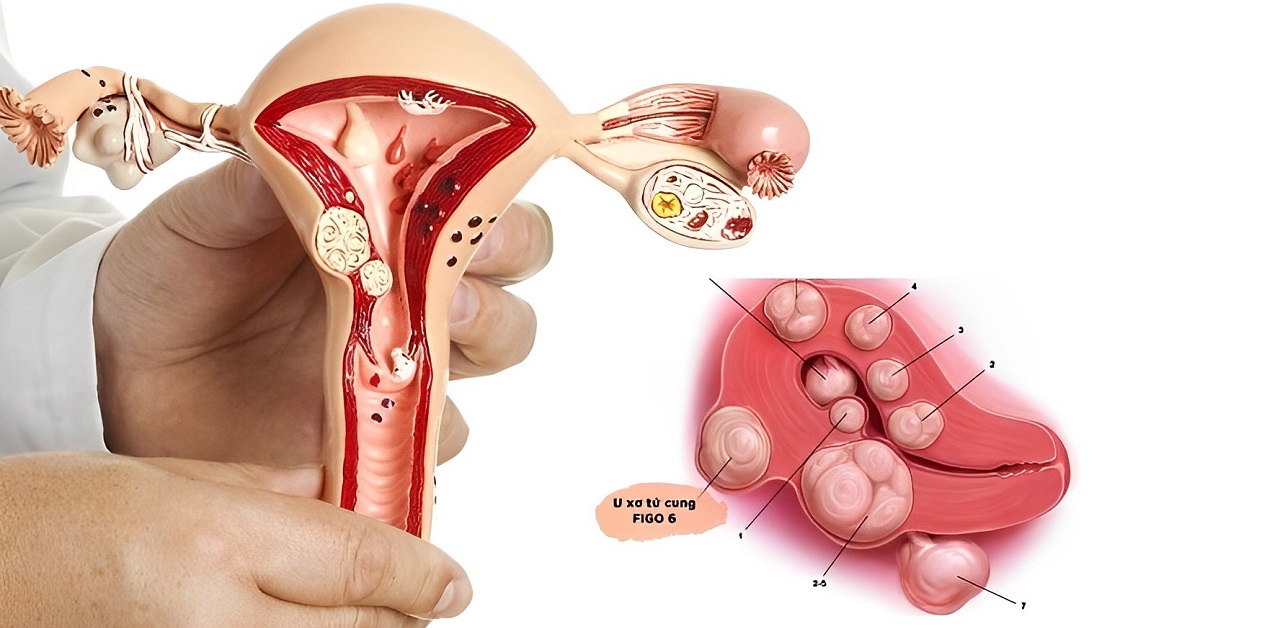 Cách phân loại, phân biệt nhân xơ tử cung với u xơ tử cung