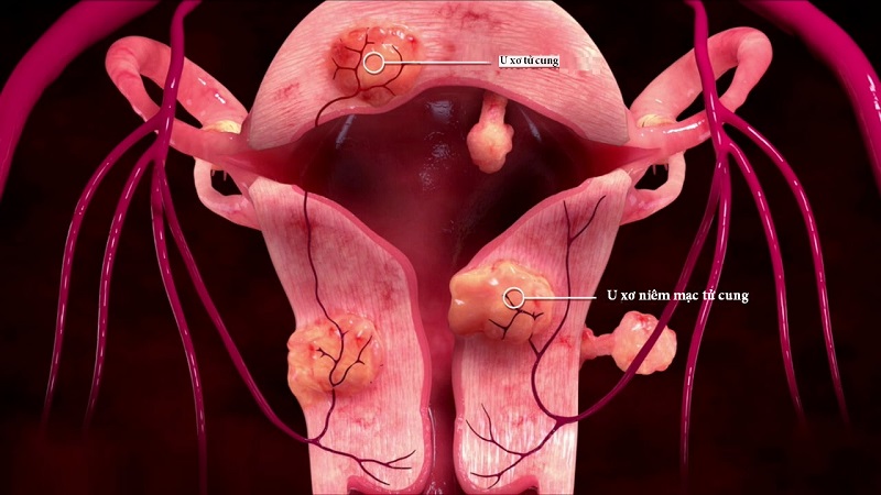 Cách phân loại, phân biệt nhân xơ tử cung với u xơ tử cung