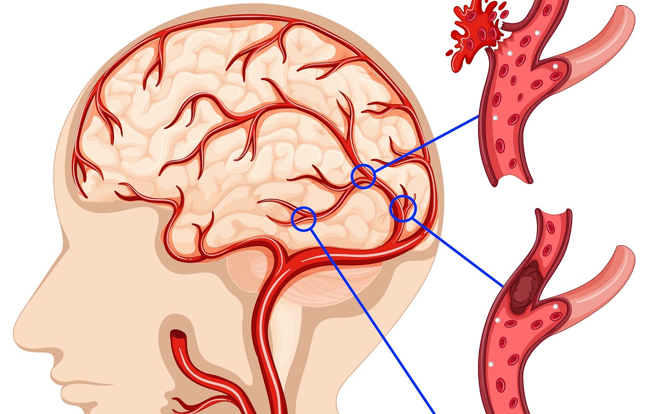 Cách phát hiện đột quỵ và sơ cứu đúng cách