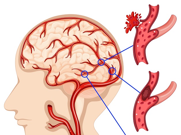 Cách phát hiện đột quỵ và sơ cứu đúng cách