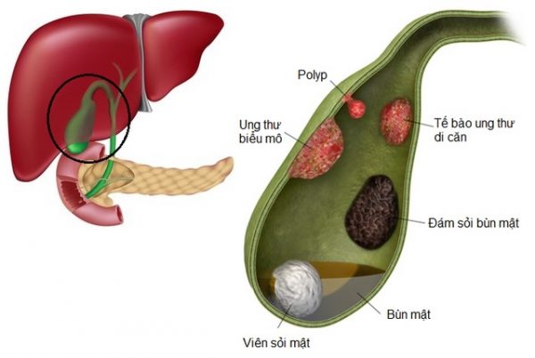 Cách phát hiện polyp túi mật trên siêu âm