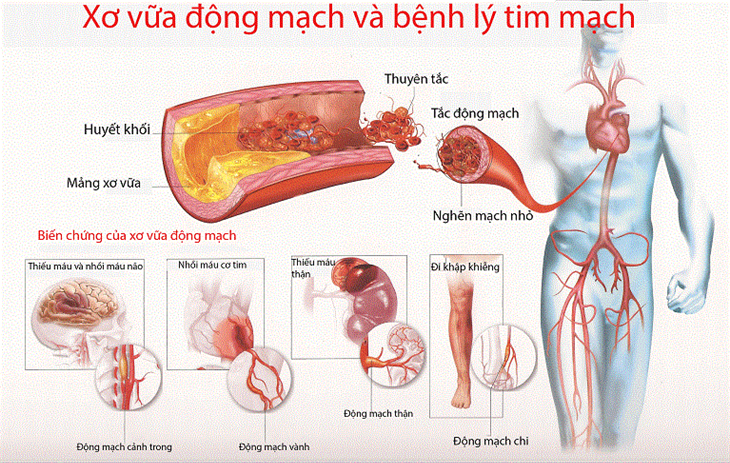 Cách phát hiện sớm nhồi máu cơ tim