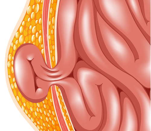 Cách phẫu thuật thoát vị bẹn