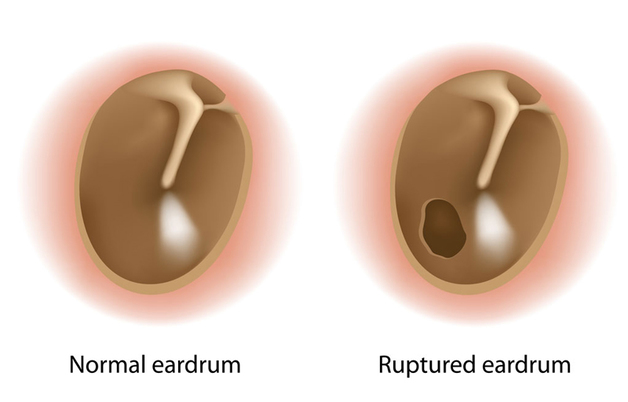 Cách phẫu thuật vá màng nhĩ nào tốt hiện nay
