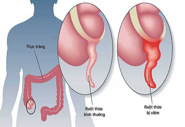 Cách phòng chống bệnh viêm ruột thừa