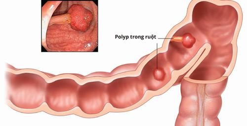 Cách phòng tránh polyp đại tràng