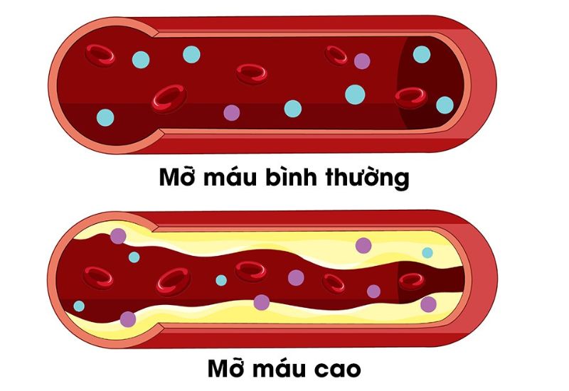 Cách sử dụng Lipanthyl 200mg trong điều trị giảm mỡ máu