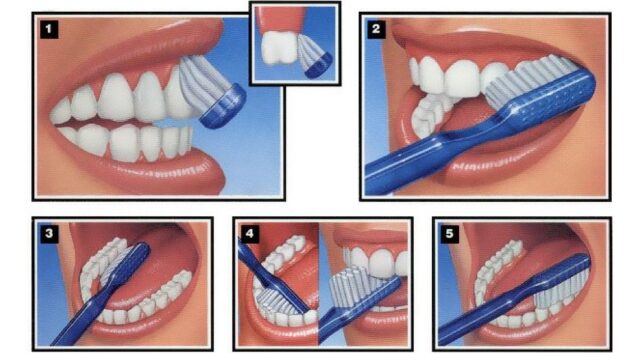 Cách tẩy mảng bám trên răng đảm bảo an toàn, hiệu quả