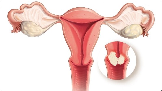 Cách tốt nhất để phát hiện sớm ung thư cổ tử cung