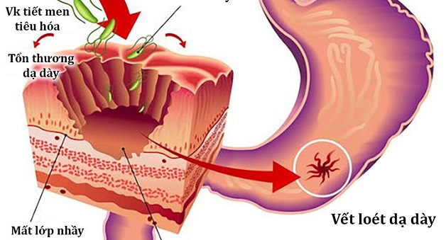 Cách trị dạ dày hp hiệu quả ai cũng cần biết