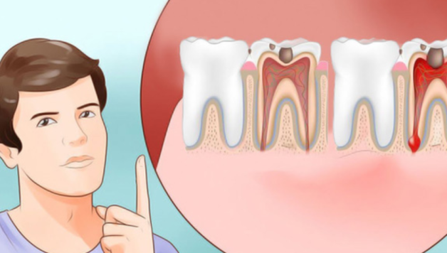 Cách trị sâu răng tại nhà từ thiên nhiên