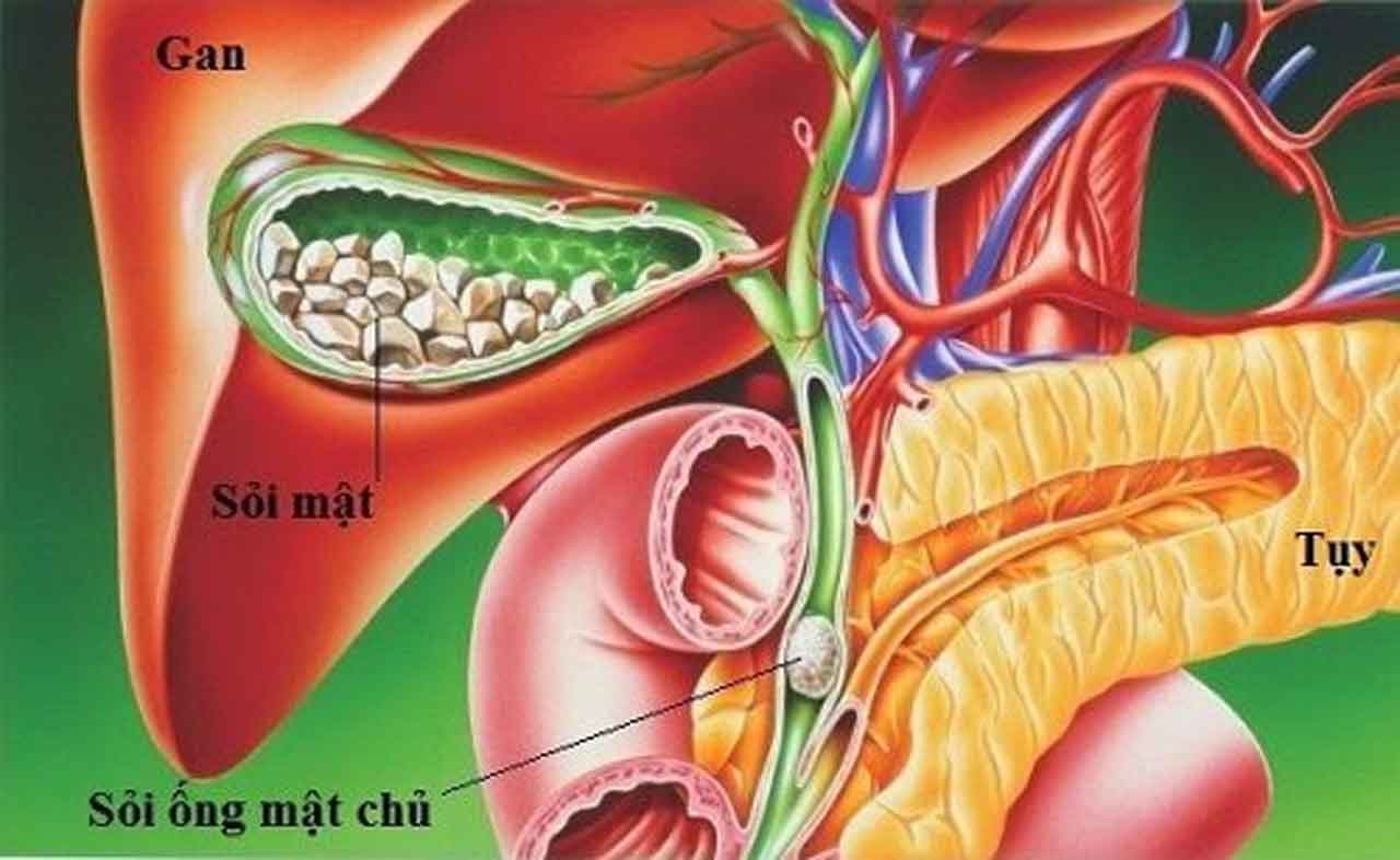 Cách trị sỏi mật hiệu quả bạn cần biết