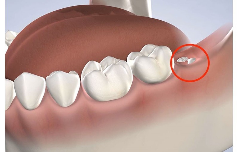 Cách xác định khi nào nhổ răng khôn