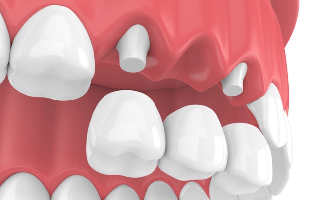 Cách xử lý răng số 5 hàm trên bị sâu