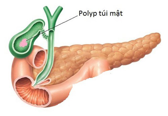 Cách xử trí khi mắc polyp túi mật 8mm