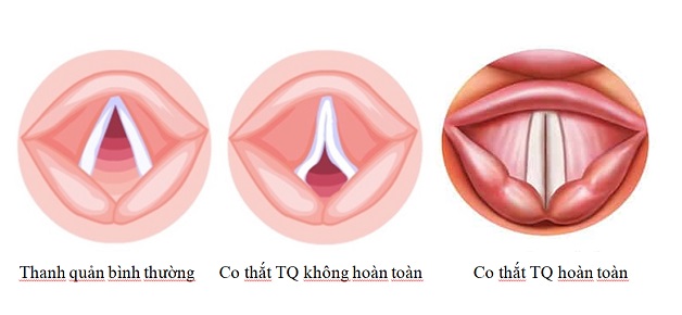 Cách xử trí nhanh cơn co thắt thanh quản