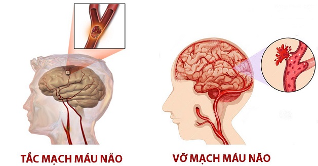 Cách xử trí và điều trị kịp thời bệnh tai biến mạch máu não