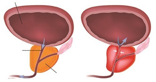 Cách xử trí viêm tiền liệt tuyến