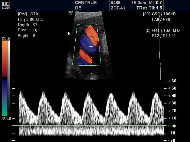 Cẩm nang cho mẹ bầu muốn siêu âm doppler thai nhi