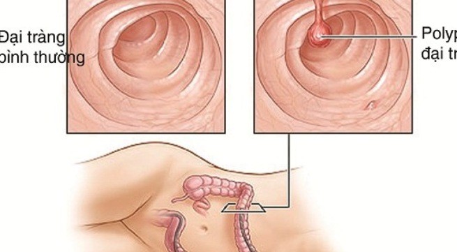 Cần biết: Cách phòng tránh và điều trị polyp đại trực tràng