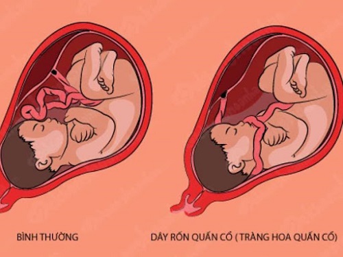 Cận cảnh bé trai chào đời an toàn với 3 vòng dây rốn quấn cổ