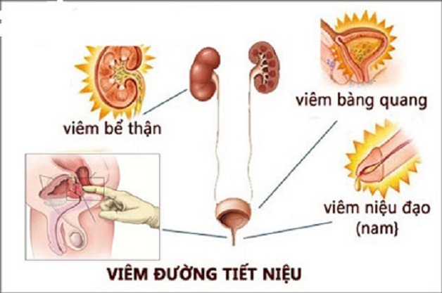 Cần cảnh giác với bệnh nhiễm trùng đường tiết niệu