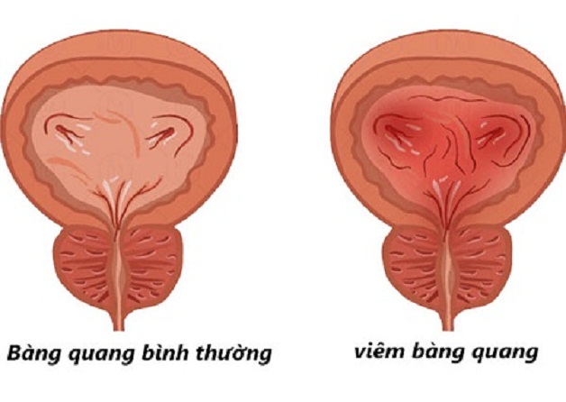 Cần cảnh giác với hiện tượng sỏi thận chạy xuống bàng quang